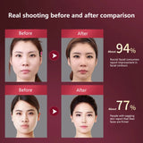 LED Photon Therapy Facial Slimming